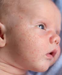 Jun 26, 2021 · hanung bramantyo tak lagi menunjukkan gejala setelah menjalani 10 hari isolasi mandiri. Baby Skin Care 101