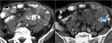 Common findings small nodules in a perilymphatic distributi. The Radiology Assistant Peritoneal Pathology