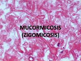Juan camilo botero1, luis fernando moreno2, luis carlos. Mucormicosis Zigomicosis Ppt Descargar