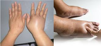 Phù tay chân hay phù toàn thân là dấu hiệu của bệnh lý gì? - Bệnh viện Việt  ĐứcBệnh viện Việt Đức