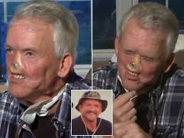 Hunter who survived The Revenant-style bear attack reveals incredible  transformation after surgeons rebuilt his FACE