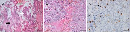 Under a microscope, sarcomatoid tissue. Localized Biphasic Malignant Mesothelioma Presenting As A Giant Pelvic Wall Mass A Rare Case Report And Literature Review Bmc Medical Imaging Full Text