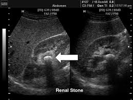Renal Colic Rcemlearning