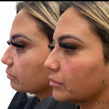 Meilani Aesthetics•（@meilani_aesthetics）• Instagram 相片與影片