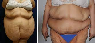 This means if you're getting health coverage for someone 18 or younger, dental coverage must be available for your child either as part of a health. Insurance And Plastic Surgery After Massive Weight Loss Dr Jason Hall