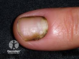 Image result for Akutní zánět nehtového lůžka