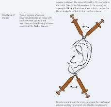 Image result for Ear Nerve Block