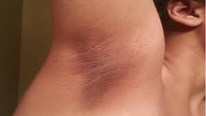 The strongest risk factor for developing skin cancer is ultraviolet (uv) ray exposure, typically from the sun. 3 Quick Ways To Get Rid Of Armpit Lumps Pulse Nigeria