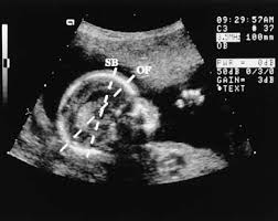 Prepare to settle in — because your ob will be looking at everything (heart, lungs. Diagnostic Obstetric Ultrasound Glowm