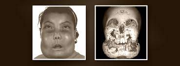 Cherubism is a rare autosomal dominant disease of the jaw and maxilla. Cherubism Study Reichenberger Lab