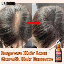 It also increases blood circulation to the scalp, which aids in overall hair growth, dr. Caffeine Hair Growth Essential Oil Hair Grower Vitamin E Hair Care Effectively Stimulates Rapid Hair Growth Prevents Hair Loss Strengthens Hair And Men And Women With Thick Hair 30ml Lazada Ph