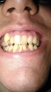Snaggle Tooth - Causes & Treatment Options
