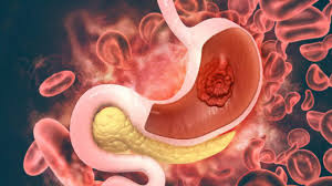 If you are worried about developing this condition, see your doctor and eliminate the danger aspects. Symptoms Of Stomach Cancer Onco Com