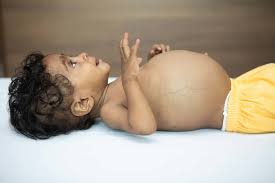 If family members develop cancer at an early age; 1 Year Old Baby Has Only A Few Weeks Left To Get An Urgent Transplant Milaap