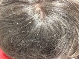 Image result for white scabs on the head in children