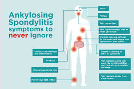 This will help you support your back as you move. Common Ankylosing Spondylitis Signs And Symptoms