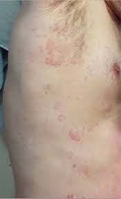 Cureus A Case Of Disseminated Lyme Disease Presenting As Chronic Urticaria