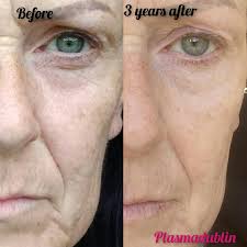 3 YEARS after plasma pen Whole eyes, and mouth! Still after that long look  at the difference especially the eyes 😍😍