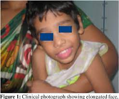 Pdf Macroorchidism As Presenting Feature Of Fragile X Syndrome Semantic Scholar