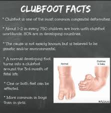 Image result for Clubfoot