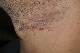 Shave with the grain of the hair instead of against it. Ingrown Hairs Pretty Faces Atlanta