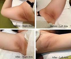 See more ideas about underarm bleaching, dark underarms, skin care. Pin On Homemade Whitening Of Teeth