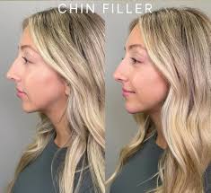 ✨ Chin Filler
