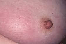 As mentioned earlier, ibc is an aggressive type of breast cancer that. Breast Cancer In Images
