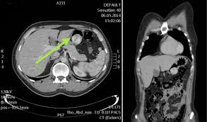 Image result for Glomus tumor