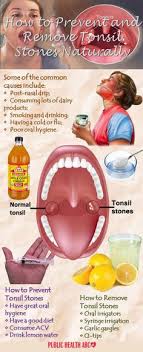 Maintain good oral hygiene tonsil stones form when bacteria and other debris gather in tiny folds on the surface of your tonsils. Tonsil Stones