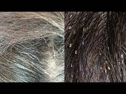 head lice or dandruff ask the expert 310 874 4550 click here for the no 1 itchy scalp da guttate psoriasis treatment psoriasis remedies scalp psoriasis