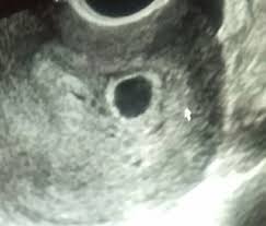 The journey has officially begun, although a few women might just be discovering and confirming their pregnancy around this. Chances Of Missed Twin At 6 Week Ultrasound Multiples And Twins Forums What To Expect