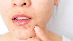 acne 10 surprising causes and