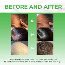 Below are before and after pictures to show the results of using biotin for hair growth. Buy Biotin Hair Growth Serum Advanced Topical Formula To Help Grow Healthy Strong Hair Suitable For Men And Women Of All Hair Types Hair Loss Support By Pureauty Naturals Online In Turkey
