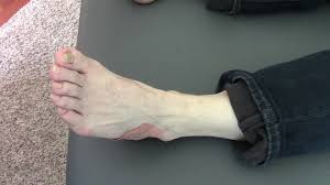 Pain down the outside of the foot which it is important to rest from aggravating activities while the foot heals from cuboid subluxation. Cuboid Syndrome Treatment Part 1 Of 2 By Jerry Hesch