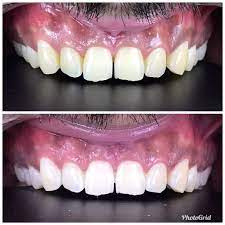 Teeth whitening typically costs between $99 to $367 per session: Dentistry How Much Rupees Yellow Teeth Whitening Costs Quora