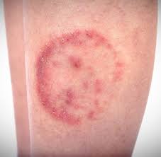 Image result for Skin Infection