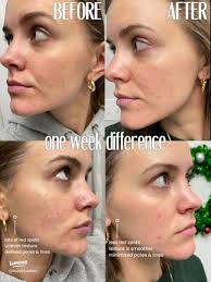 One Week of Red Light Therapy: My Skin Transformation