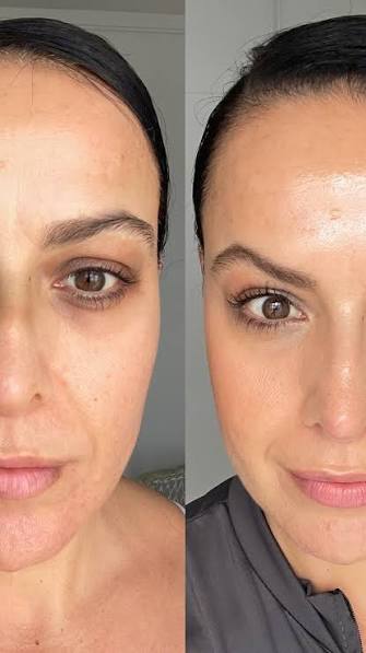 Por fin mi antes y después con el nuevo serum de Retinol 😍 jamas use un  producto igual , #retinolserum #retinolskincare #acne #arrugas #manchaspiel
