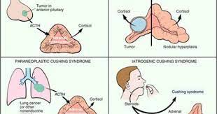 Cards Week 4 Pituitary And Adrenal Pathology Cushings Syndrome Autoimmune Autoimmune Disease