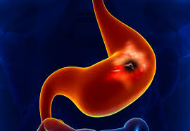 These cancerous cells often spread to nearby organs and to other parts of the body. Breath Test Breakthrough For Early Diagnosis Of Oesophageal And Gastric Cancer Imperial News Imperial College London