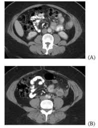 Human reproduction, vol 34, № 3. Abdominopelvic Dissemination Of Benign Uterine Tissue Following Surgical Power Morcellation