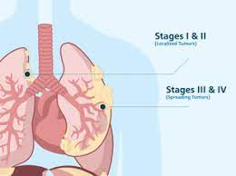 Pains in chest area (may also appear in areas outside of the chest area such as shoulders, arms or stomach) chronic dry cough troubles swallowing coughing blood unusual masses underneath skin on chest unusual weight loss Pleural Mesothelioma Causes Symptoms Treatment And Top Doctors