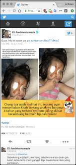 Mata juling atau dalam istilah medis dikenal dengan strabismus terjadi akibat adanya gangguan koordinasi pada otot penggerak bola mata. Salah Syndrome Juling Turnbackhoax