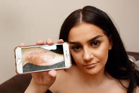 Teen holiday rep reveals horror scars after motorbike crash in Zante  wearing just a bikini