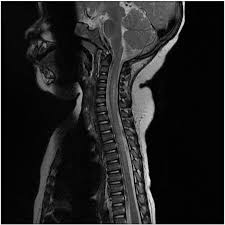 Here are the transverse myelitis symptoms, causes, and diagnosis. Acute Transverse Myelitis In A Pediatric Patient The American Journal Of Emergency Medicine