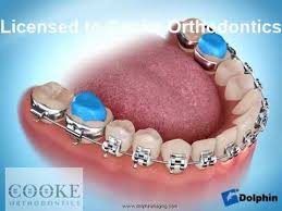 Pin On Braces