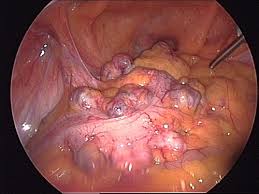 Image result for Diverticulitis