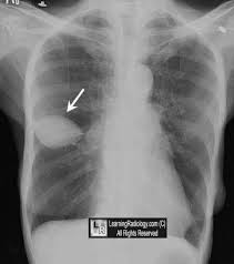 Paeudotumor Vanishing Tumor Fissural Effusion Mimicking A Lung Mass Radiology Medical Thoracic
