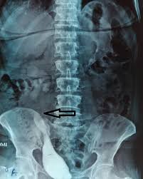 Image result for Intravenous Pyelogram